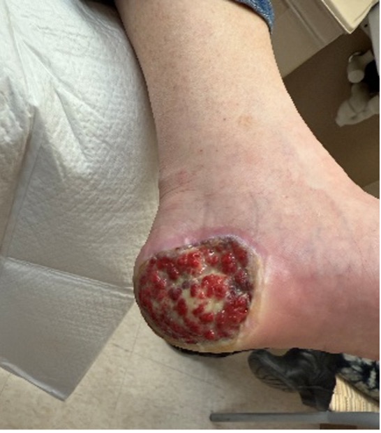 Figure 4. Status-post surgical excision of melanoma.