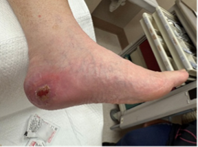 Figure 5. Wound healing progression at 3 months status post-surgical excision of melanoma