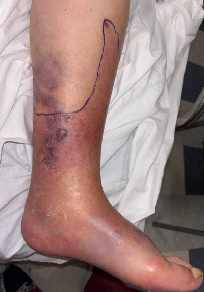Figure 1. Initial clinical presentation of Vibrio vulnificus necrotizing fasciitis.