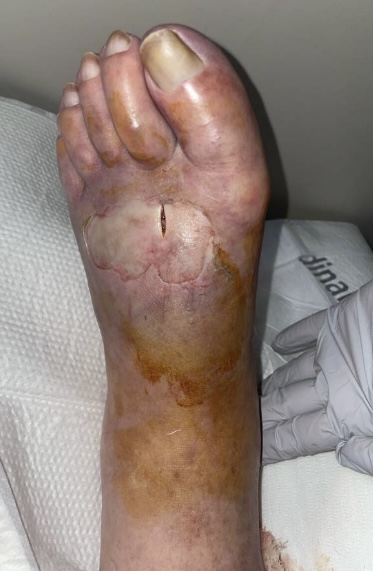 Figure 2. This photo reflects the clinical picture after an initial bedside incision and drainage.