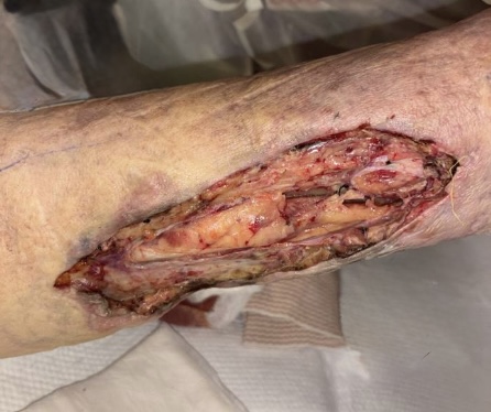 Figure 3a. This image shows the area of concern after surgical debridement.