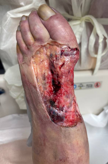 Figure 3b. This image shows the area of concern after surgical debridement.
