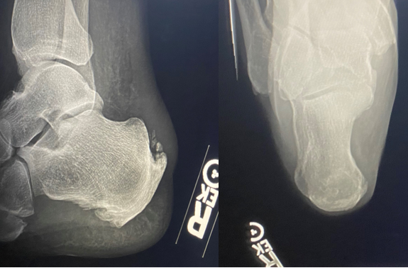 Figure 1. Calcaneal radiographs of the right foot, showing no fracture or dislocation, but enthesophytes in the area of concern.
