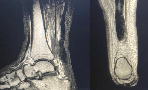 Figure 2. MRI images demonstrating 3.4 cm discontinuity of the Achilles tendon.