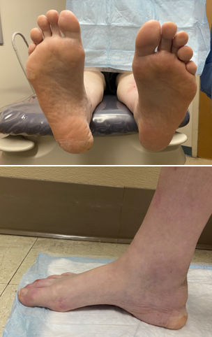Figure 3. Clinical images 4 years post-injury showing medial fat pad displacement of the right heel.
