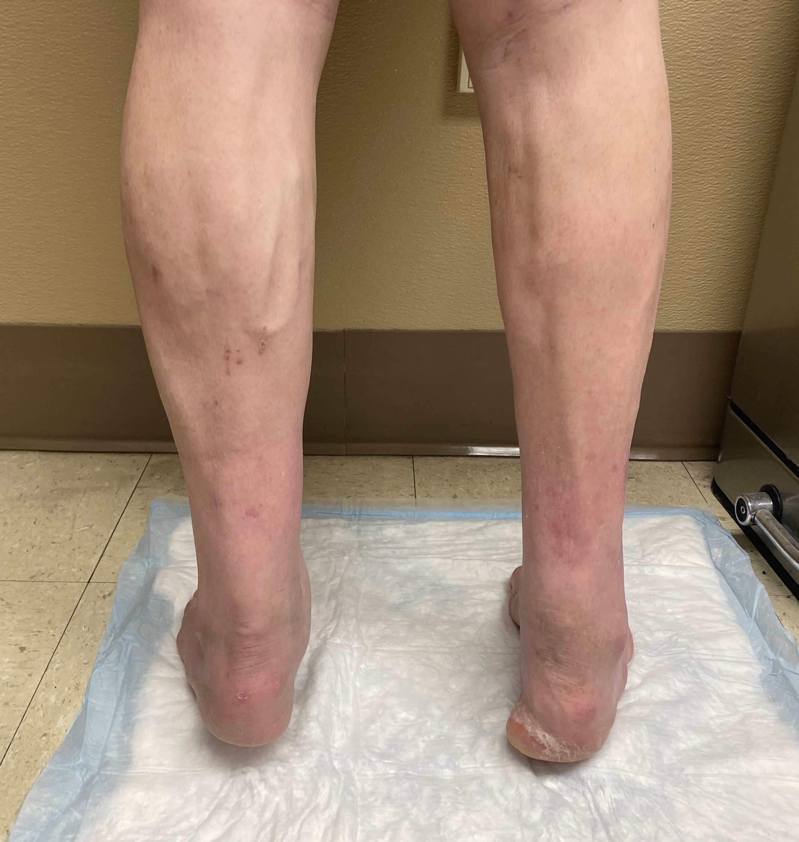 Figure 4. Clinical image in stance showing a mild varus position on the right.