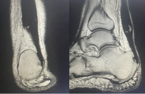 Figure 5. MRI images demonstrating remodeling and improved continuity in the area of the Achilles tendon.