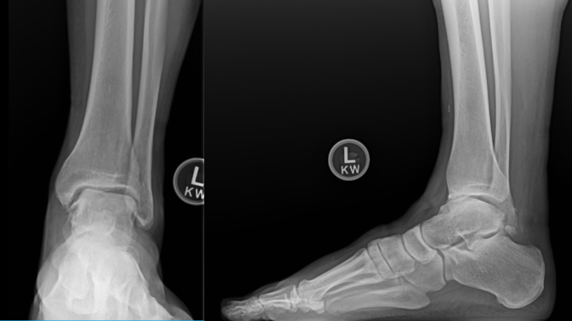 Figure 1. Weight-bearing radiographic images demonstrate chronic instability, varus malalignment, and anterior translation of the talus in relation to the tibia.