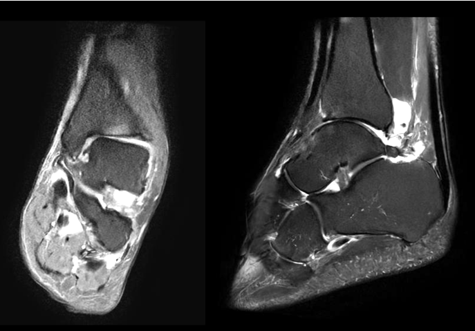 Figure 2. MRI T2-weighted images demonstrate underlying marrow edema with minimal-to-no significant chondral injury.