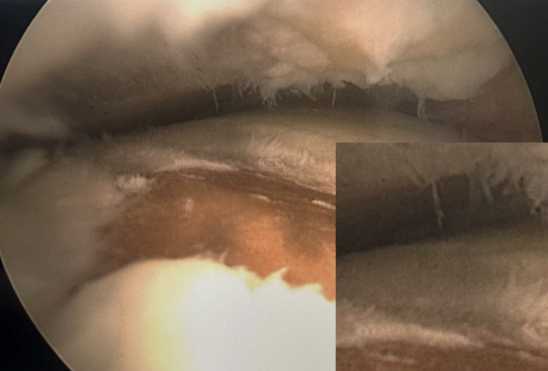 Figure 3. Direct arthroscopic visualization of the medial talar shoulder chondral injury and articular delamination.