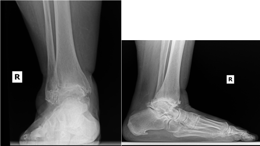 Figure 5. Radiographic images demonstrating end-stage degenerative ankle arthritis. 