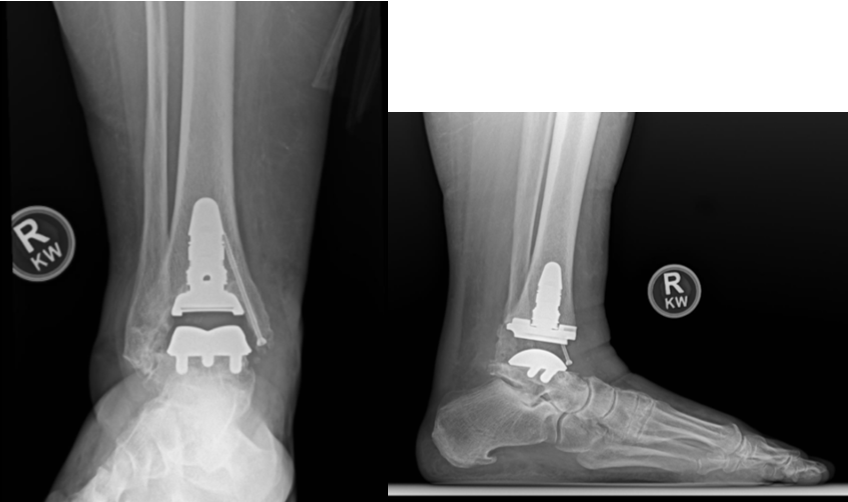 Figure 6. Example of a fourth-generation INBONE II (Stryker) TAR with prophylactic medial malleolar fixation.
