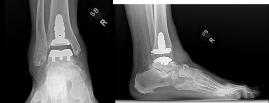 Figure 9. Postoperative example of INBONE II tibia and Adaptis talus components.
