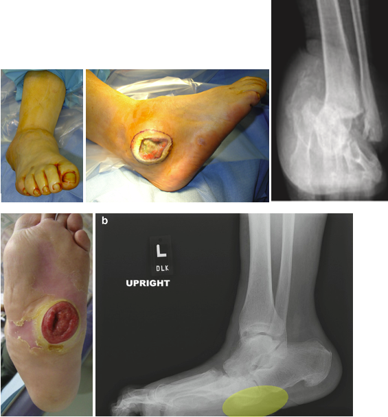 Figure 1. Charcot hindfoot subluxation can lead to lateral ulcerations due to fibula prominence as the foot displaces medially. Similarly, midfoot Charcot collapse can lead to plantar midfoot ulcerations. Bone exposure or prolonged ulcerations will increase risk of developing osteomyelitis.