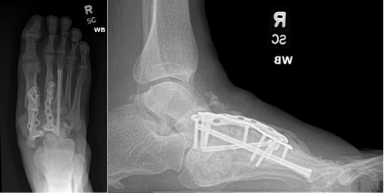 Figure 2. Initial presentation of 61-year-old male with prior midfoot Charcot neuroarthropathy arthrodesis 6 months prior. Following physical therapy, the patient developed a second Charcot event at the talonavicular joint.
