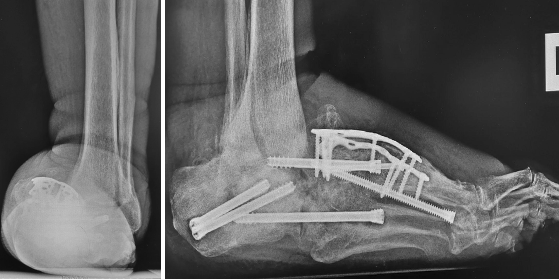 Figure 3. Failed attempted hindfoot stabilization of the hindfoot with a triple arthrodesis as the talus underwent avascular necrosis.