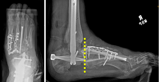 Figure 4. Final surgery resulting in plantigrade foot by fusing the entire hindfoot with a femoral allograft to restore height and unlocking the talonavicular and calcaneocuboid joints to allow for sagittal plane motion of the forefoot relative to the hindfoot (dotted line).