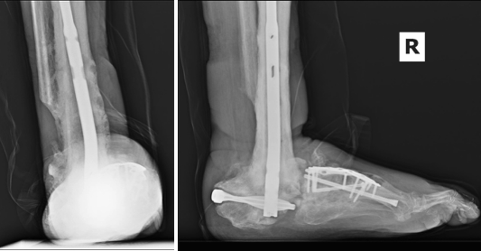 Figure 5. Full hindfoot consolidation at 5 months postop. Patient transitioned into a TayCo brace at this time to allow for forefoot sagittal plane motion to allow him to drive and ambulate independently.