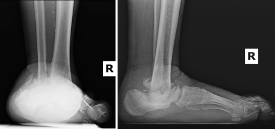 Figure 6. Patient is a 47-year-old male with diabetes mellitus and ESRD who sustained a ground level ankle fracture 1 year ago. The talus is dislocated with an unstable ankle Charcot deformity. There is no midfoot instability or gross deformities. 
