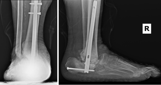 Figure 7. Patient underwent talectomy, bone grafting, and tibiocalcaneal arthrodesis that is fixated with an intramedullary nail. The hindfoot was brought back in alignment with the long axis of the tibia and there is motion through the midfoot. 