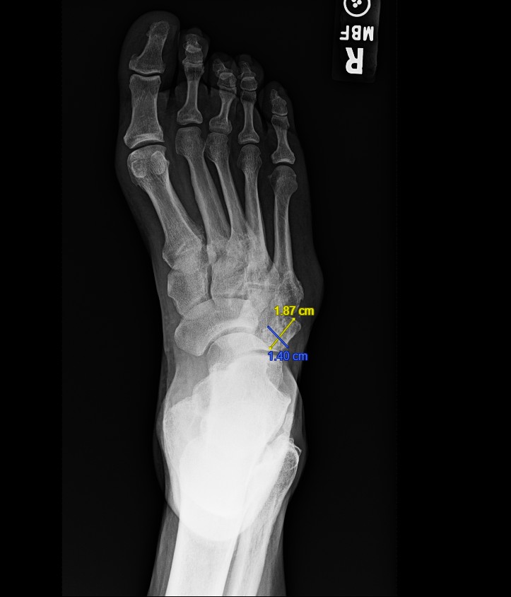 Figure 1. Dorsoplantar radiograph of the right foot showing the os cuboideum secundarium.