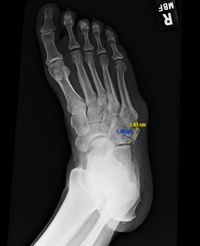 Figure 2. Oblique radiograph of the right foot showing the same ossicle. 