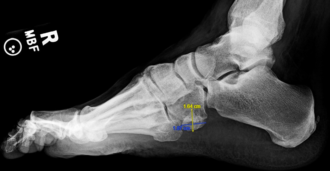 Figure 3. Lateral radiograph of the right foot also exhibiting the os cuboideum secundarium.