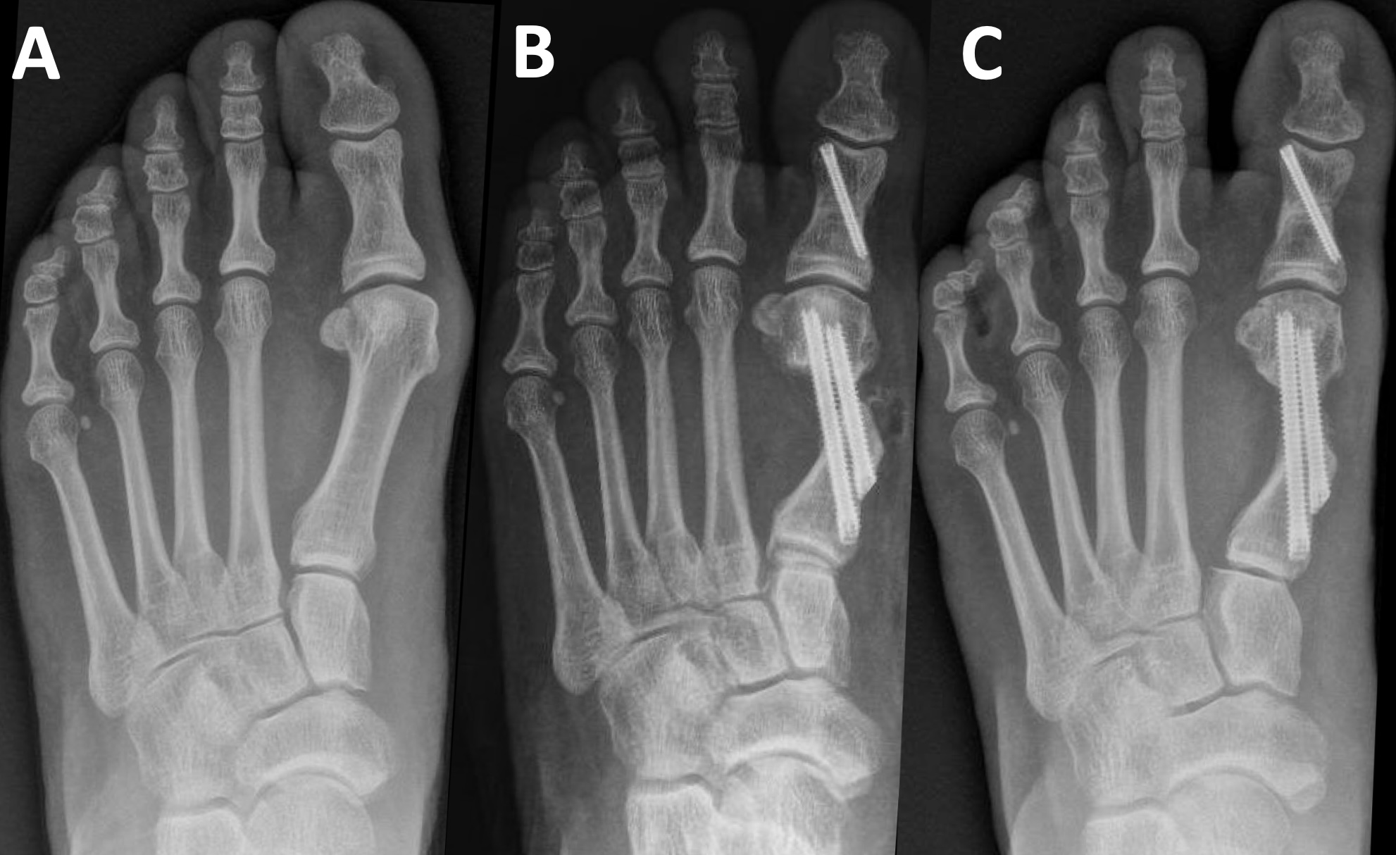 Figure 1. Case 1 radiographs of minimally invasive bunion correction. (A) Preoperative weight-bearing. (B) Immediate postoperative non-weight-bearing. (C) Three-month postoperative follow-up.