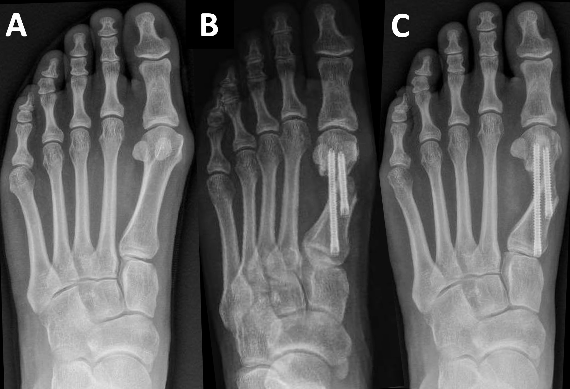 Figure 2. Case 2 radiographs of minimally invasive bunion correction. (A) Preoperative weight-bearing. (B) Immediate postoperative non-weight-bearing. (C) Three-month postoperative follow-up.