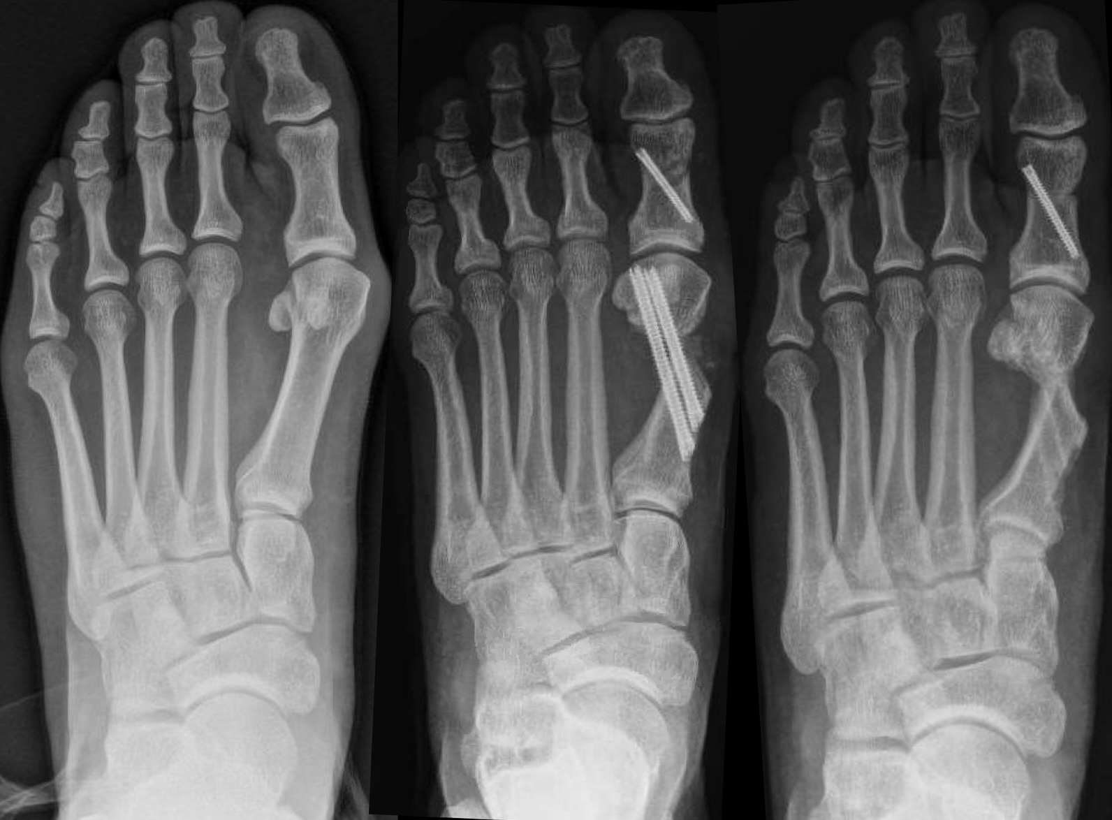Figure 3. Case 3 radiographs of minimally invasive bunion correction. (A) Preoperative weight-bearing. (B) Immediate postoperative non-weight-bearing. (C) Fourteen-month postoperative follow-up. 