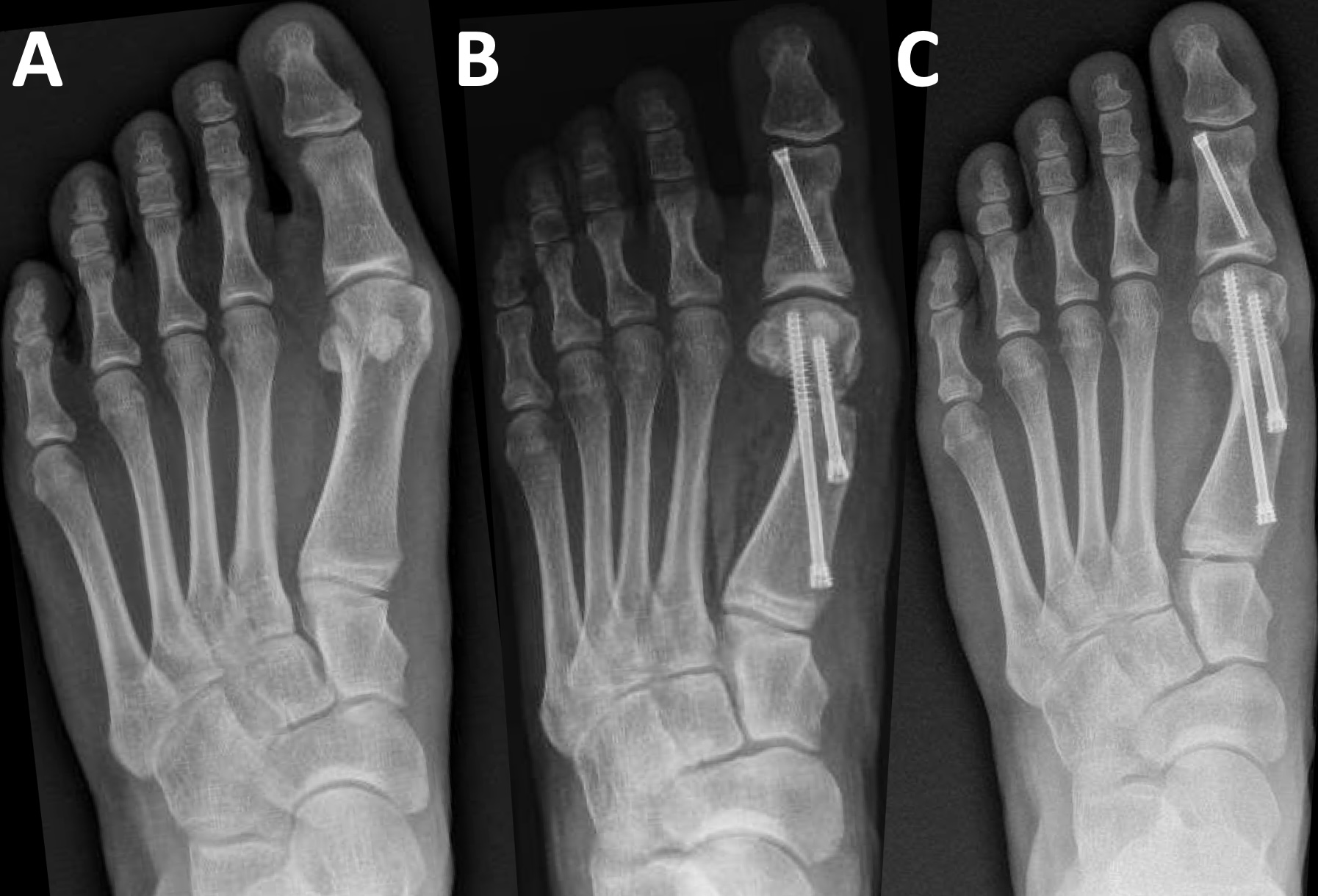 Figure 4. Case 4 radiographs of minimally invasive bunion correction. (A) Preoperative weight-bearing. (B) Immediate postoperative non-weight-bearing. (C) Eight-month postoperative follow-up.
