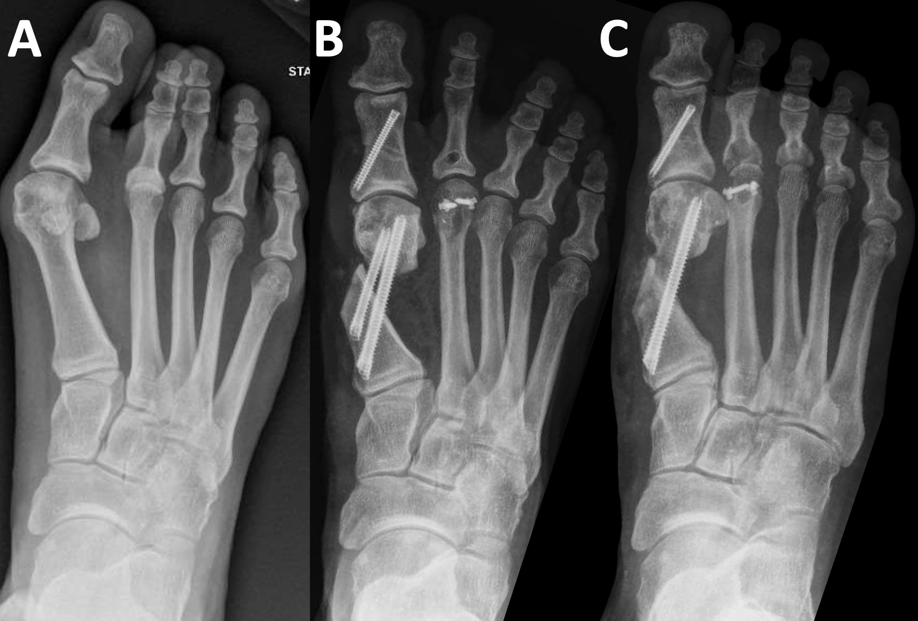 Figure 5. Case 5 radiographs of minimally invasive bunion correction. (A) Preoperative weight-bearing. (B) Immediate postoperative non-weight-bearing. (C) Ten-month postoperative follow-up.