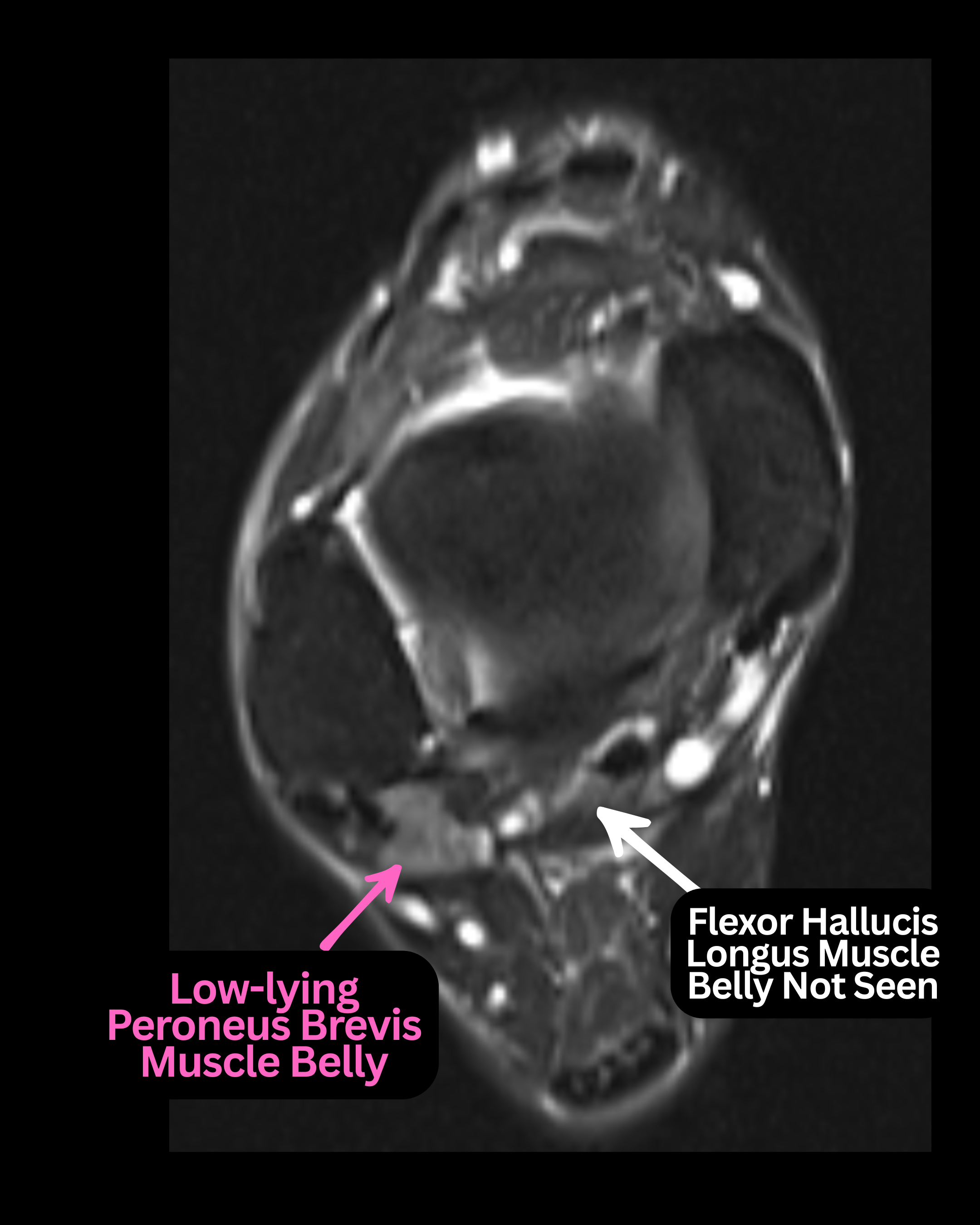 Figure 1. Peroneal tendinosis with surrounding fluid, suspicious for possible peroneal tendon pathology