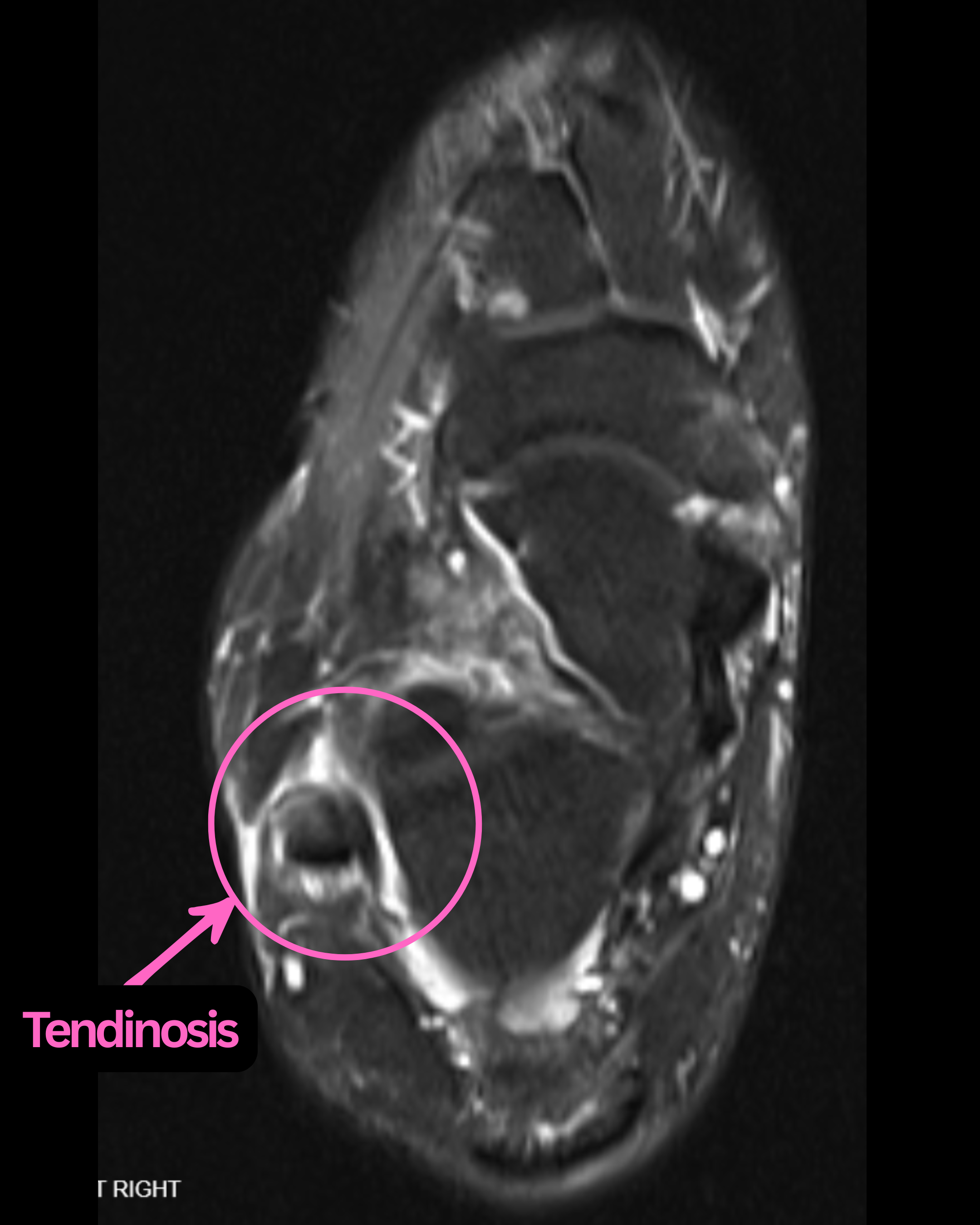 Figure 2. Split peroneus brevis tendon noted on each side of a normal peroneus longus tendon