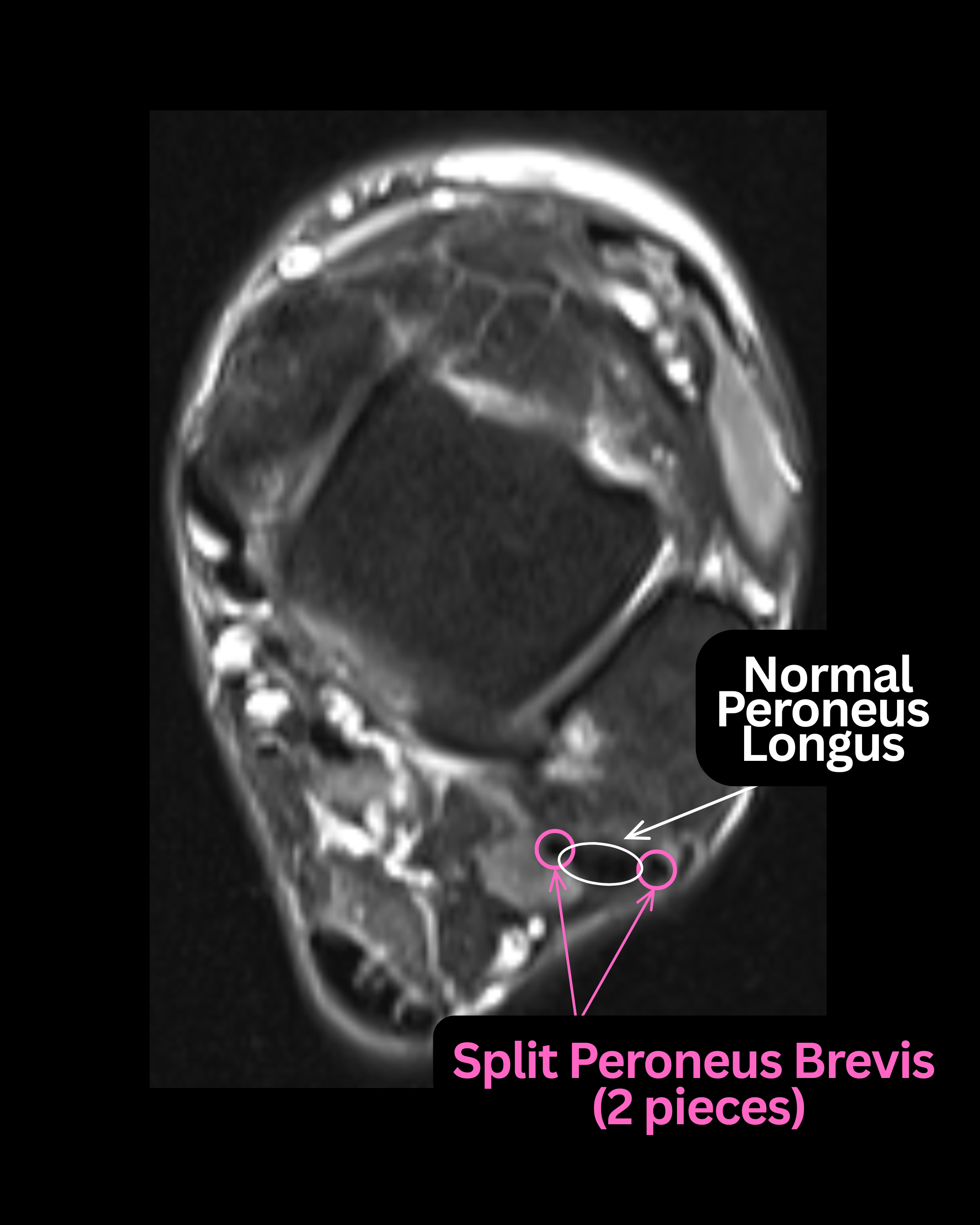 Figure 3. Crescentic peroneus brevis tear wrapped around a normal peroneus longus tendon.