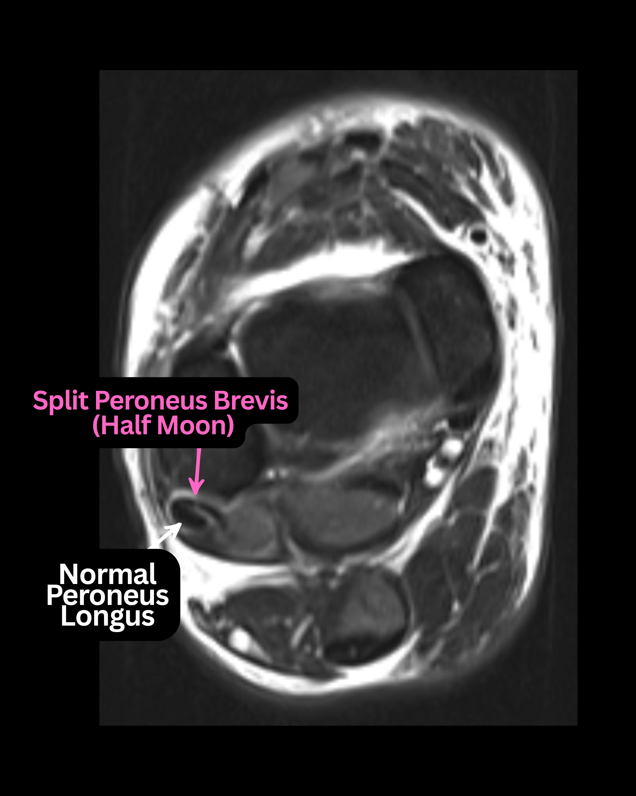 Figure 4. Low-lying peroneus brevis muscle belly present.