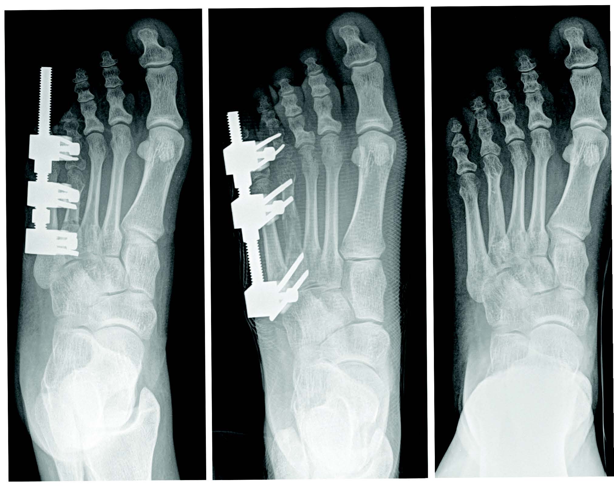 Bone Lengthening