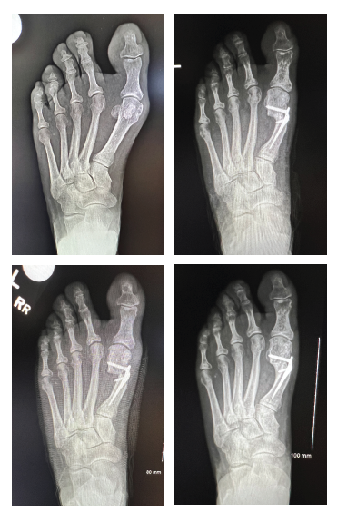 Bone Lengthening
