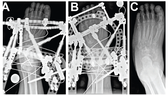 Bone Lengthening