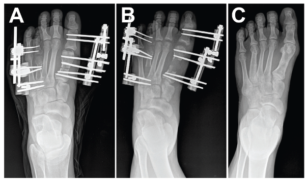 Bone Lengthening