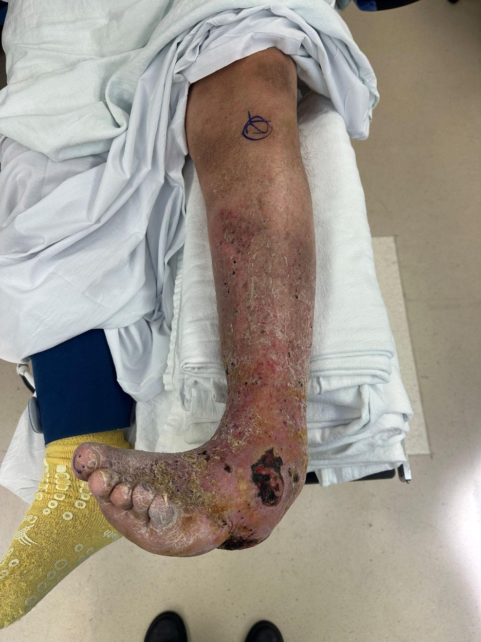 Figure 1. In this image, one can see the clinical picture of the deformity and skin condition preoperatively.