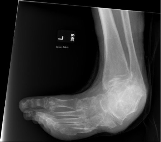 Figure 3. This preoperative radiographic image shows resting position with erosion of the fifth metatarsal base/cuboid region and fixed equinovarus positioning.