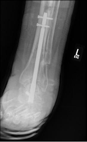 Figure 5. This image, taken 9 months after the initial surgical intervention, and 3 months post-tibiotalocalcaneal nailing, shows ongoing consolidation. There is a proximal area of lucency at the prior pin sites with no pathologic fracture or clinical concerns. 