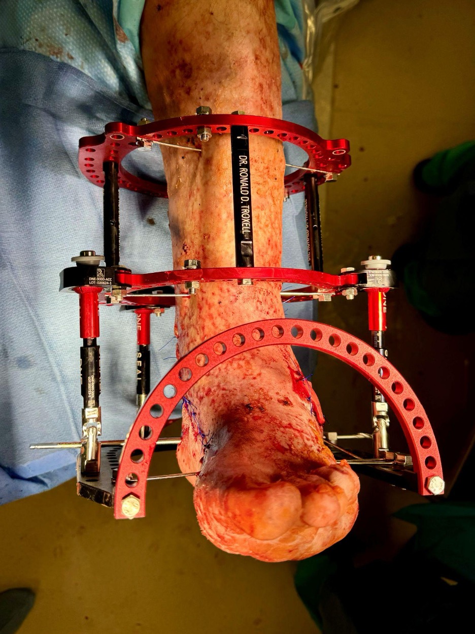 Figure 7. Intraoperative image of gross deformity correction and approach.