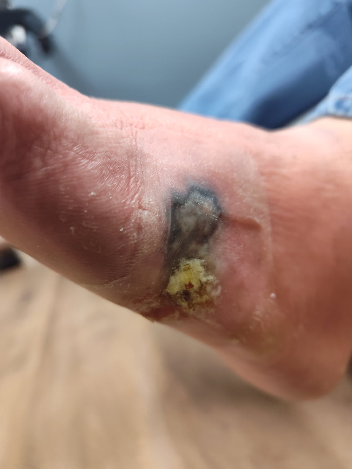 Figure 1. Here is the wound at initial patient presentation. 