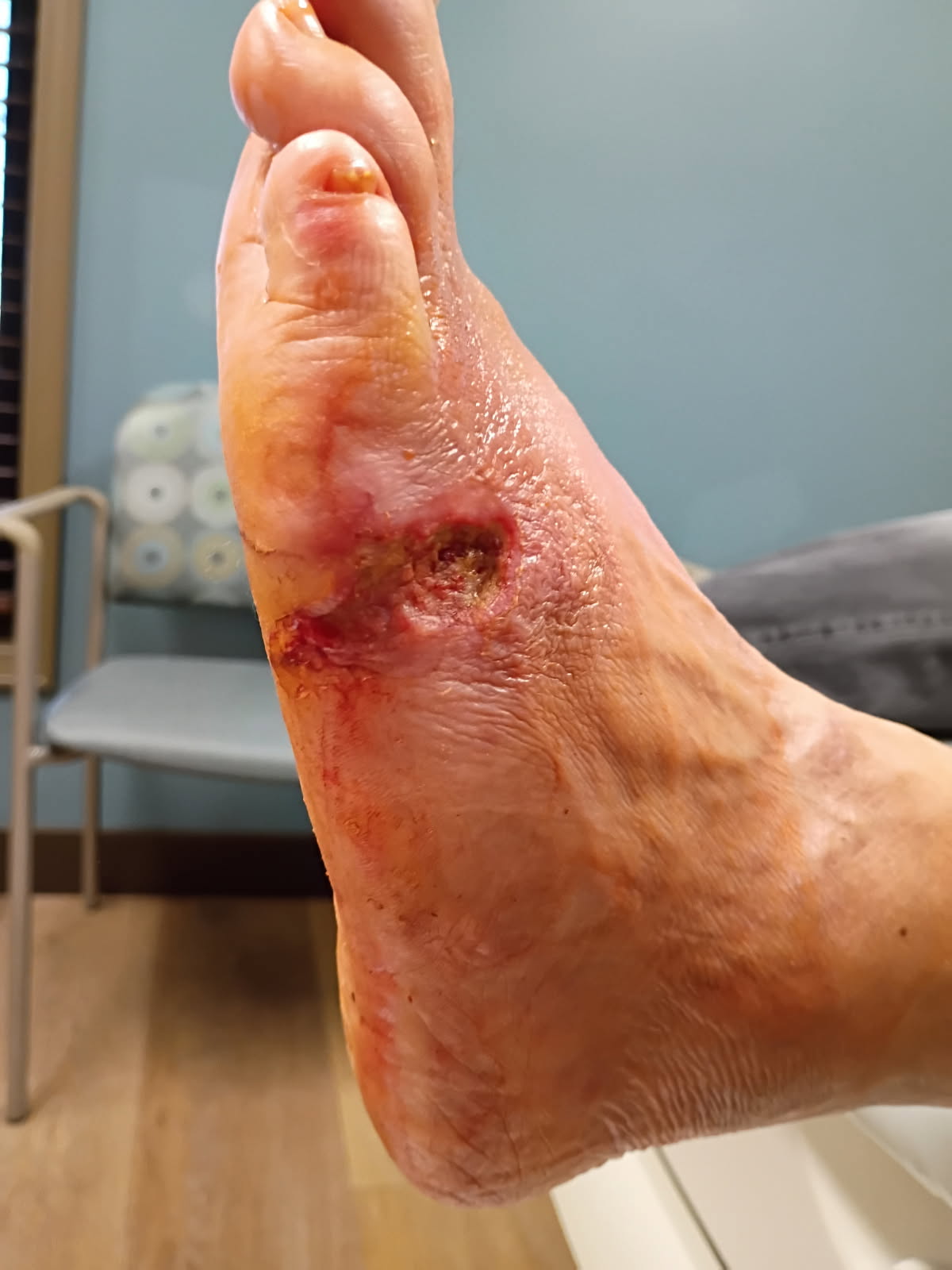 Figure 2. Here is the wound at week one of treatment. 