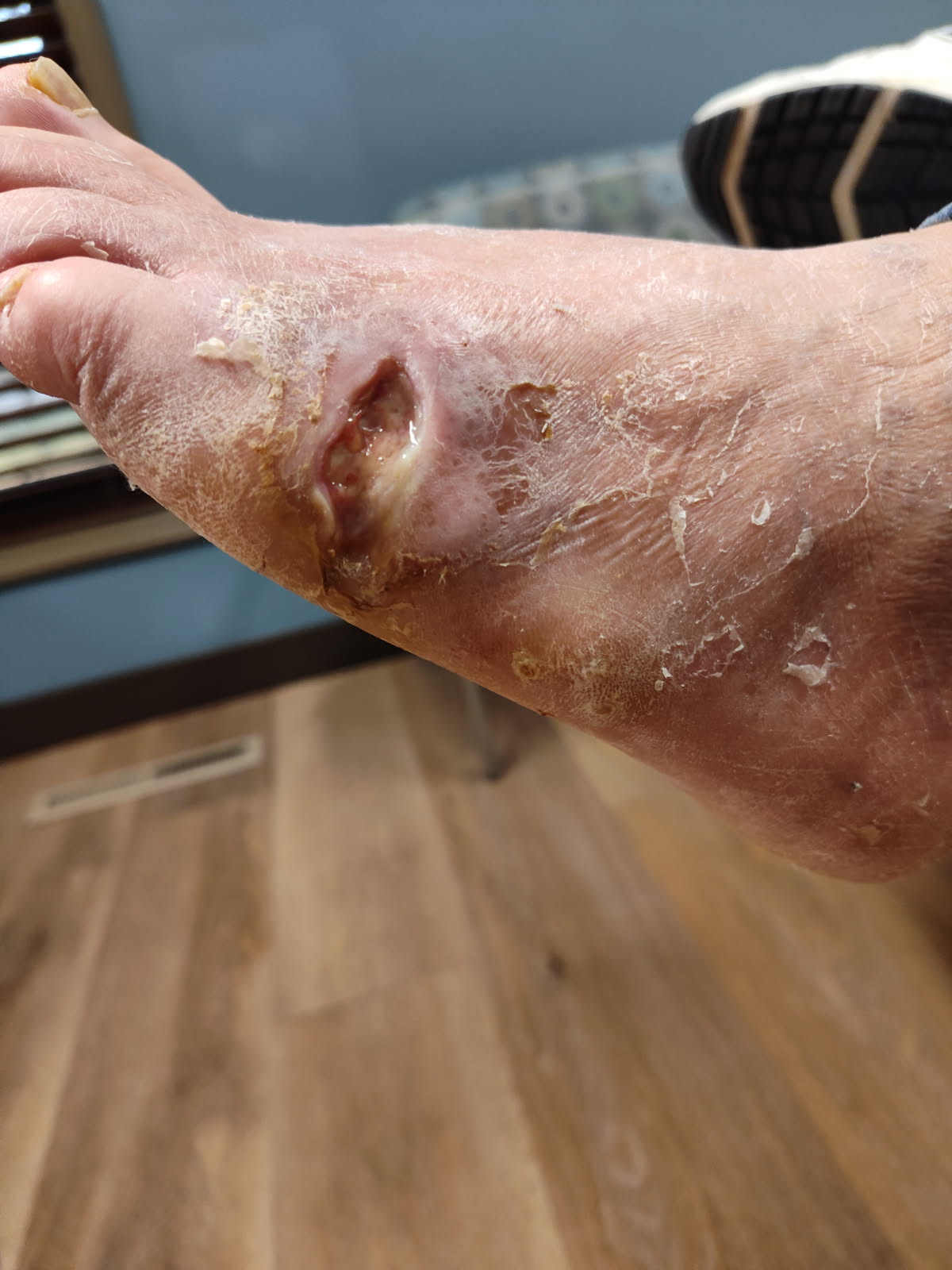 Figure 3. Here is the wound at week two of treatment. 