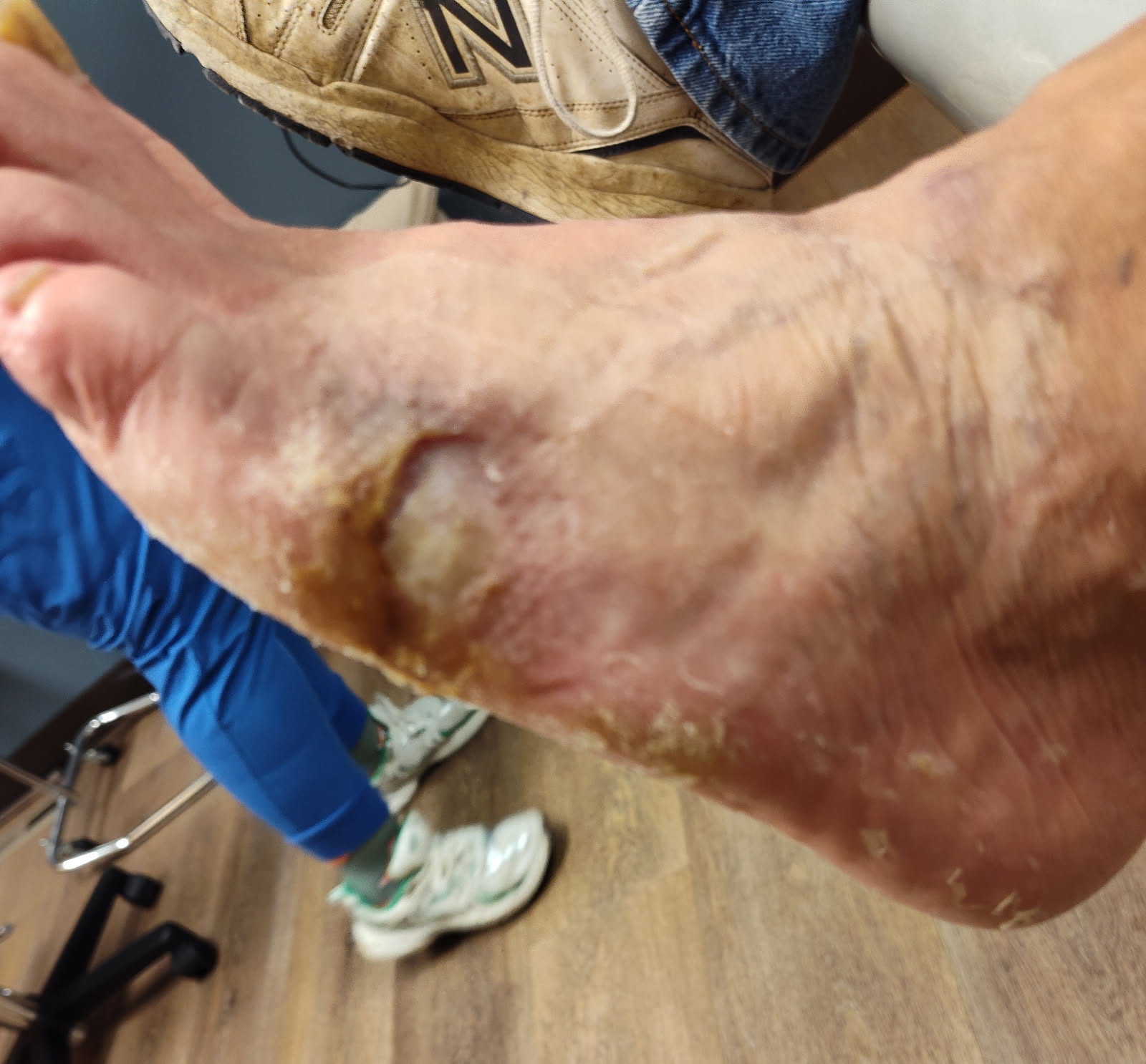Figure 5. Here is the wound at week four of treatment. 
