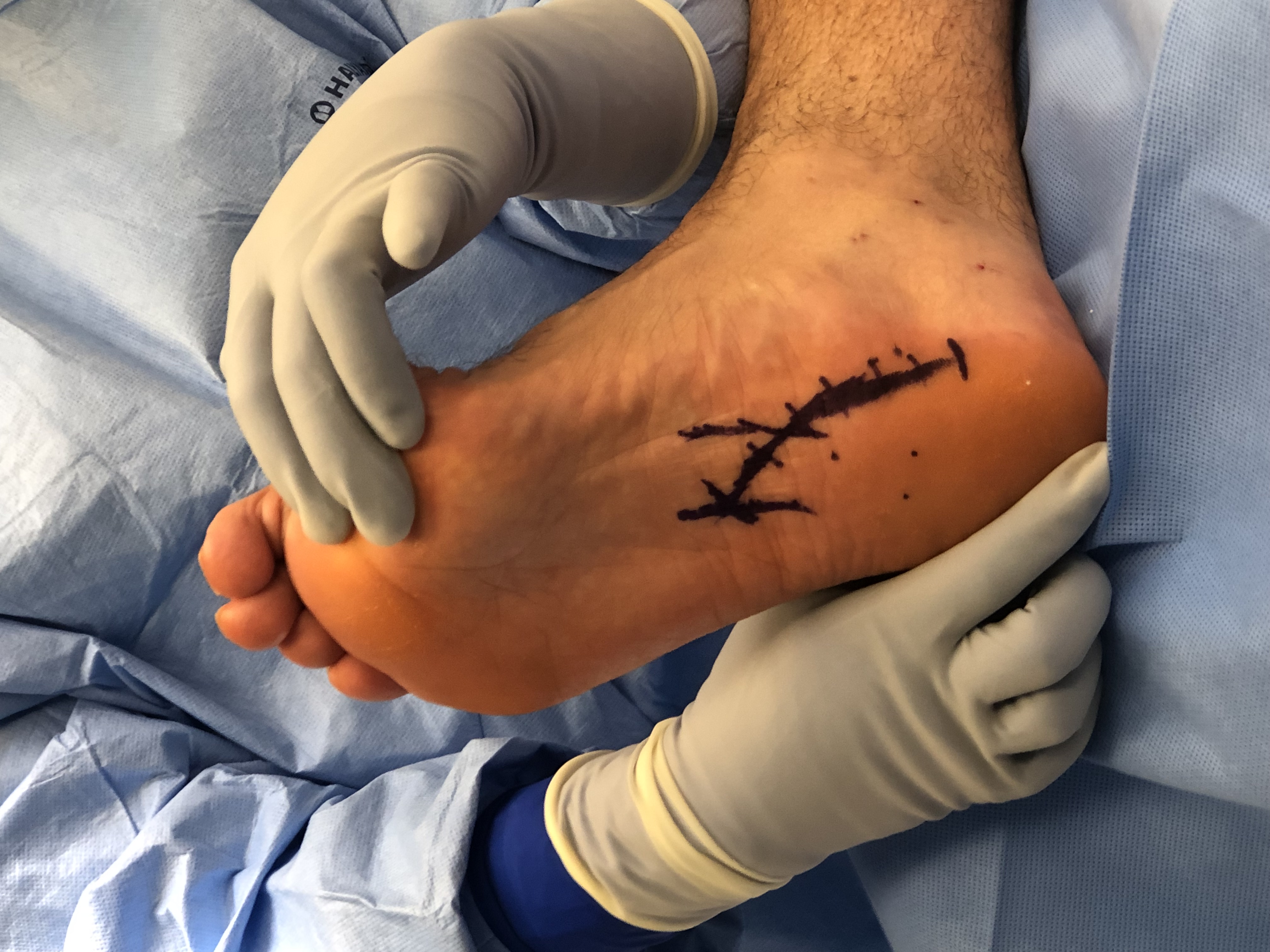 Figure 1. After sterile prep and drape, the authors made a curvilinear incision over the medial side of the right heel, extending distally and laterally over the central band of the plantar fascia.