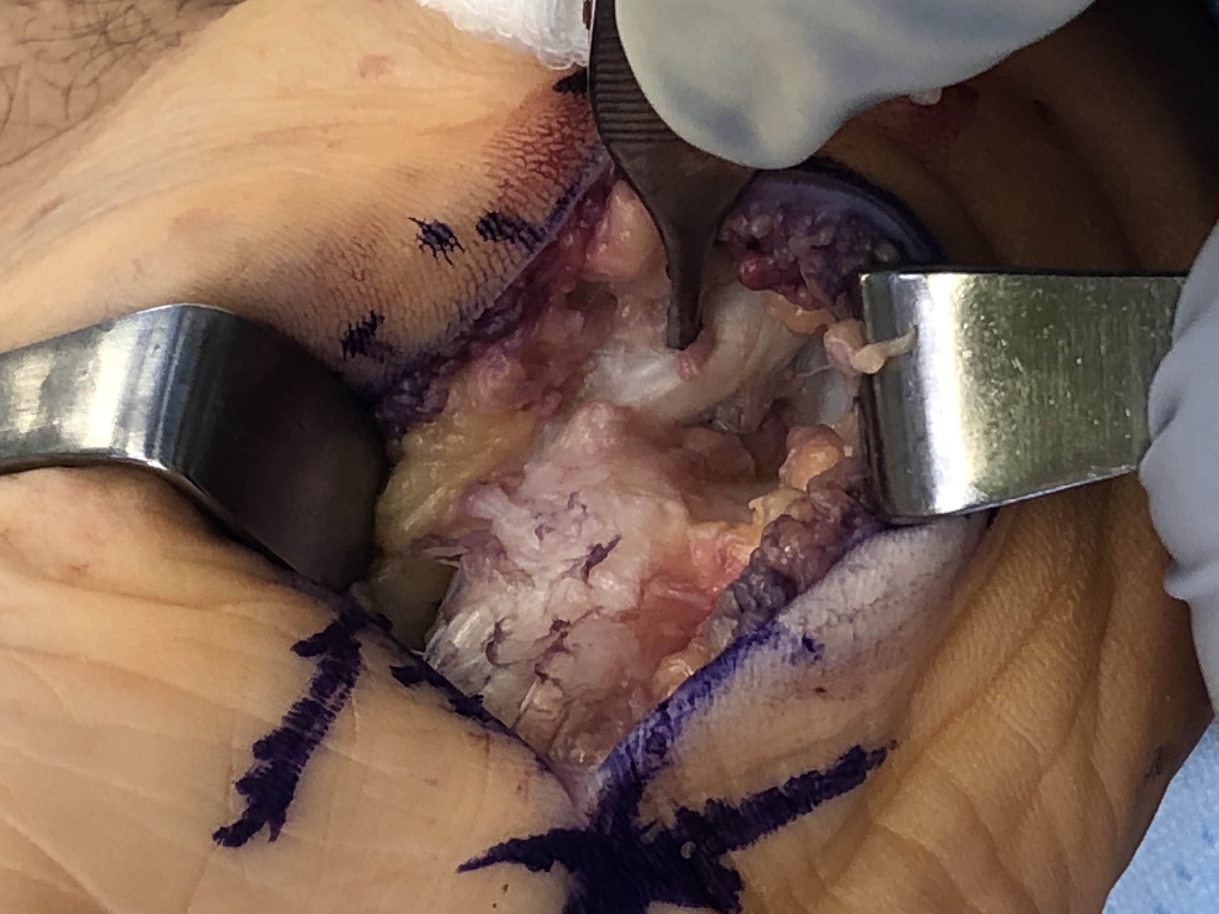 Figure 2. The authors identified the plantar fascia rupture upon exposure of the structure, approximately 2 cm distal to the calcaneal tuberosity, along with 7 mm of degenerated fascia distal to the rupture.